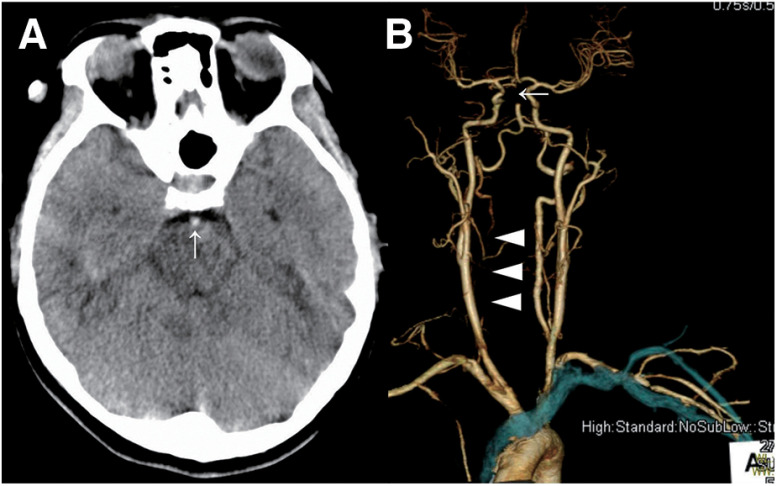 Basilar Artery Occlusion Caused by Extracranial Vertebral Artery Dissection on Its Entry into the Transverse Foramen of the C6 Vertebra: Case Report.