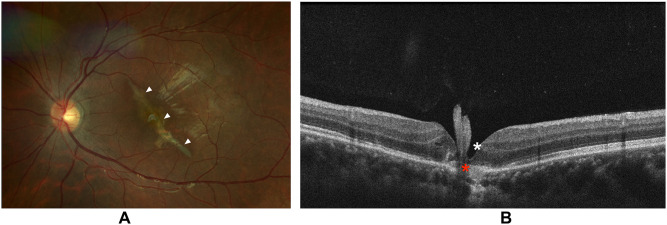 Choroidal Rupture in the Setting of Multi-Trauma.