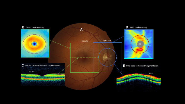 Associations Between Thinner Retinal Neuronal Layers and Suboptimal Brain Structural Integrity in a Middle-Aged Cohort.