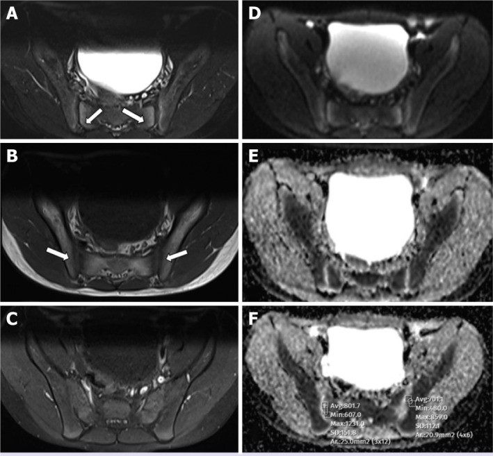 Efficacy of diffusion weighted imaging in sacroiliac joint MRI in children.