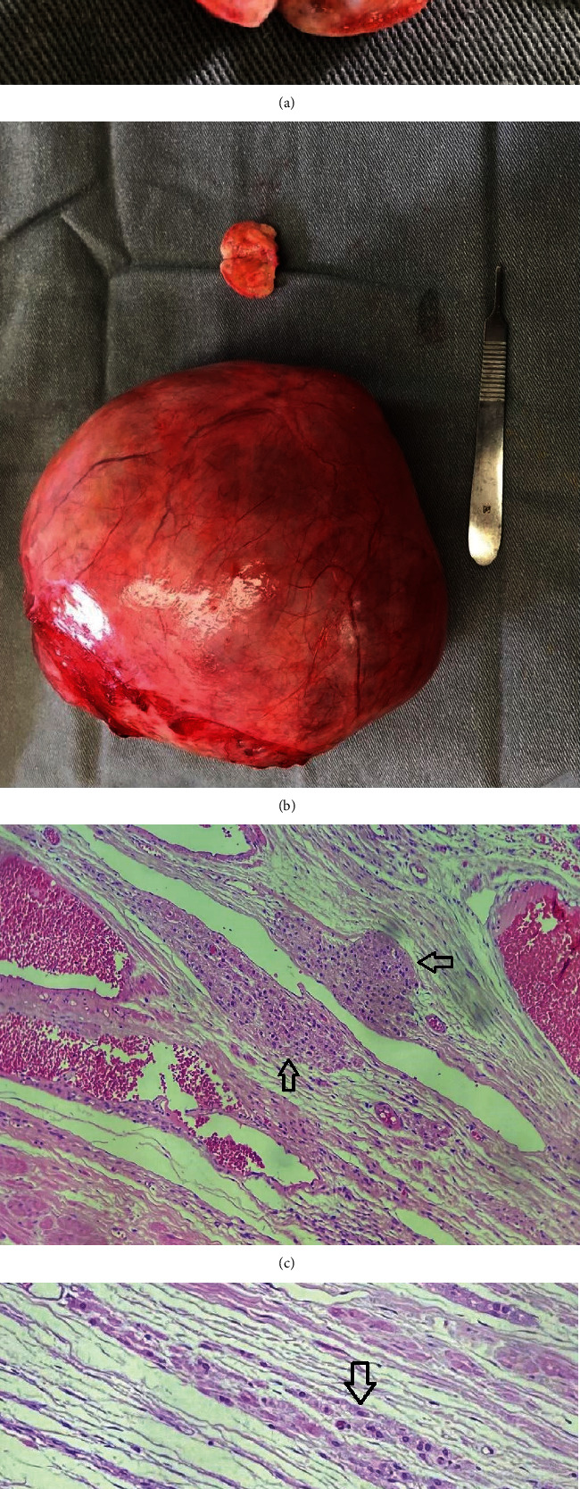 Postmenopausal Hyperandrogenism due to Ovarian Hyperthecosis.