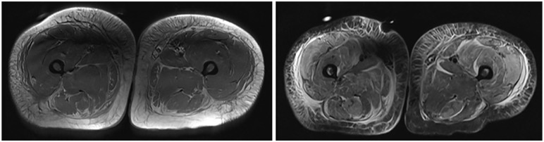 Gemcitabine-Induced Myositis in a Luminal B Breast Cancer patient: A Case Report.