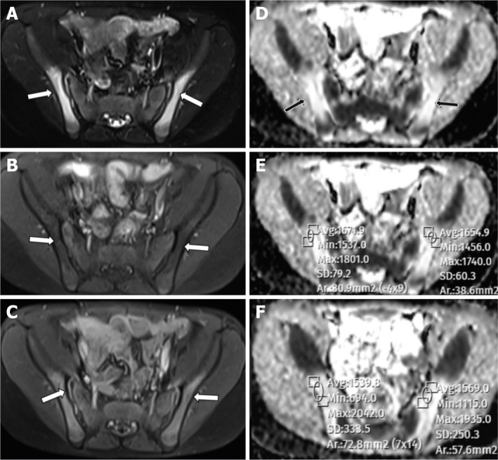 Efficacy of diffusion weighted imaging in sacroiliac joint MRI in children.