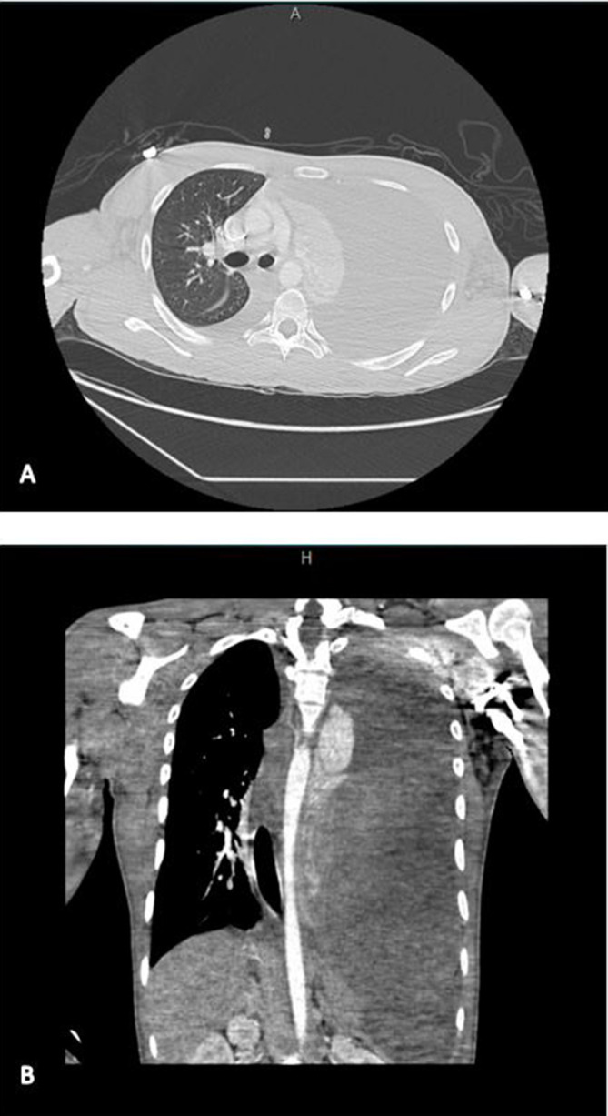 Late Onset Diaphragmatic Hernia: A Forgotten Etiology of Recurrent Vomiting in the Adolescent Population.