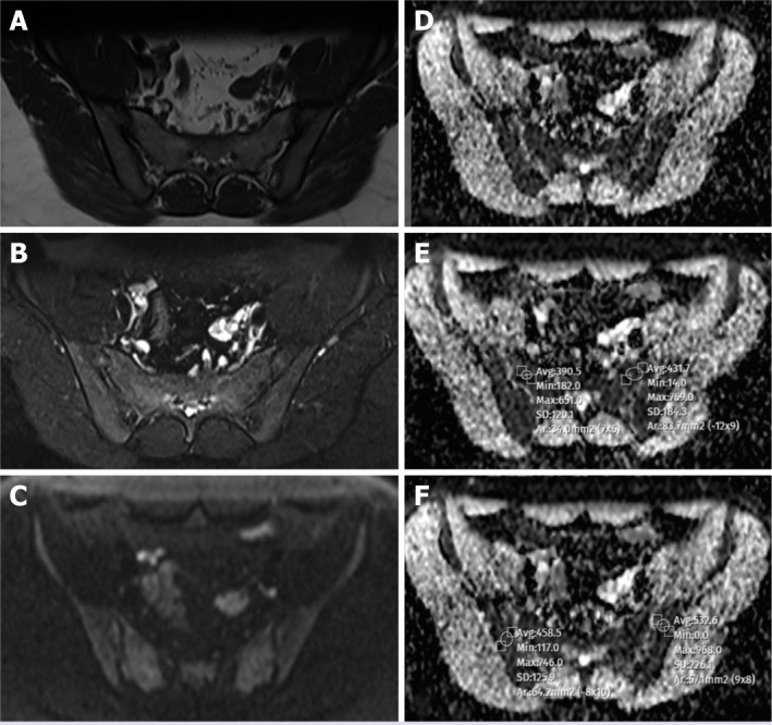 Efficacy of diffusion weighted imaging in sacroiliac joint MRI in children.