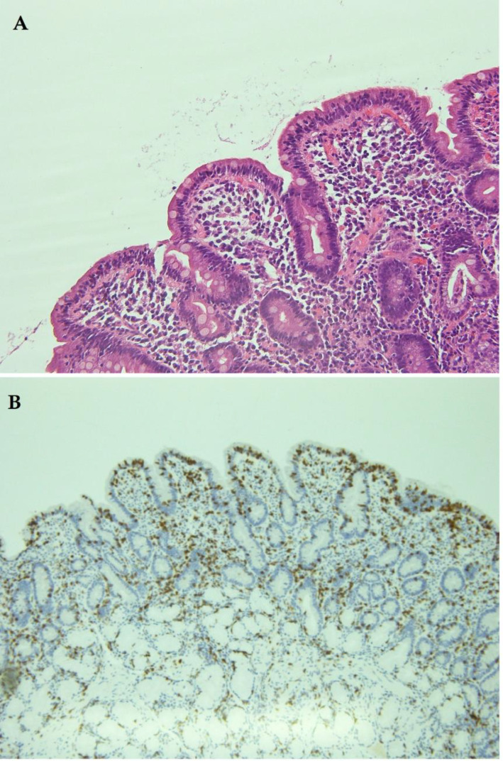 Transient non-coeliac gluten sensitivity (NCGS) with markedly reduced villous height/crypt depth ratio.