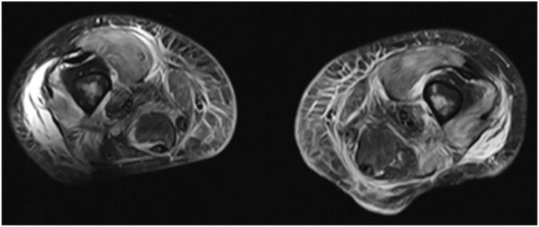 Gemcitabine-Induced Myositis in a Luminal B Breast Cancer patient: A Case Report.