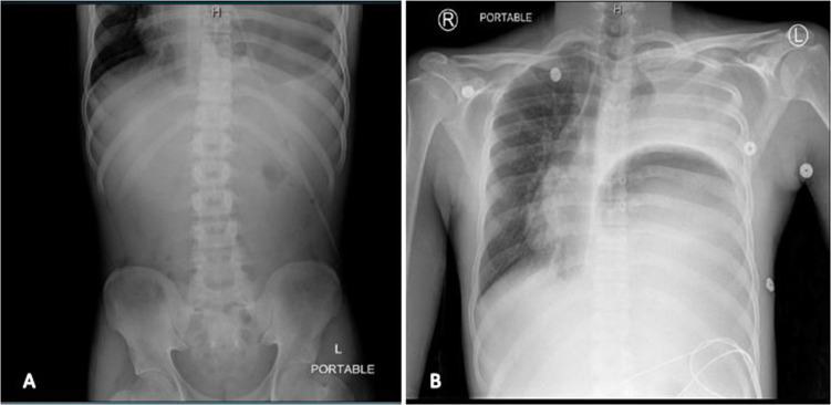 Late Onset Diaphragmatic Hernia: A Forgotten Etiology of Recurrent Vomiting in the Adolescent Population.