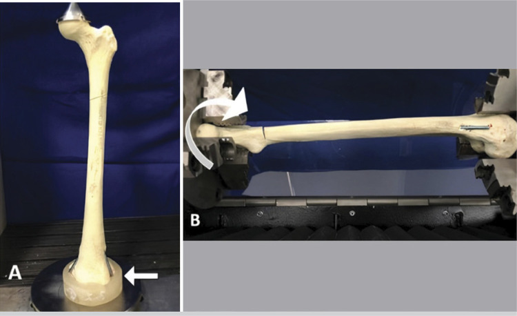 FLEXIBLE INTRAMEDULLARY NAILS IN PEDIATRIC SUBTROCHANTERIC FEMUR FRACTURE: BIOMECHANICAL STUDY.