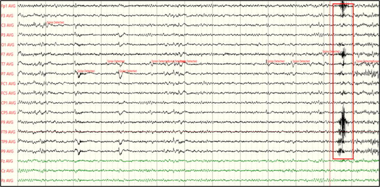 EEG biomarker candidates for the identification of epilepsy