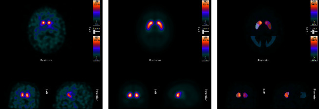 Manifestations of Intellectual Disability, Dystonia, and Parkinson's Disease in an Adult Patient with <i>ARX</i> Gene Mutation c.558_560dup p.(Pro187dup).