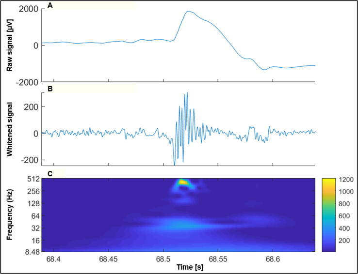 EEG biomarker candidates for the identification of epilepsy