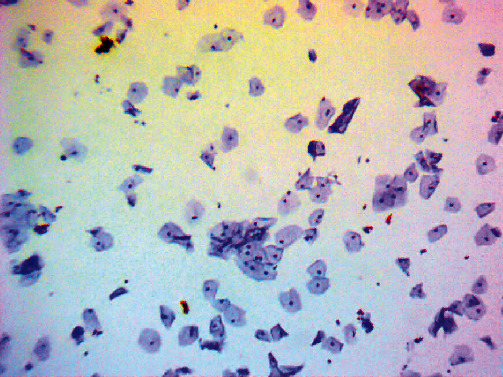 Diagnostic Accuracy of p16<sup>INK4a</sup>/Ki-67 Dual Immunostaining for Detection of High-Grade Cervical Intraepithelial Neoplasia in Women Involved in Cervical Cancer Screening in Georgia.