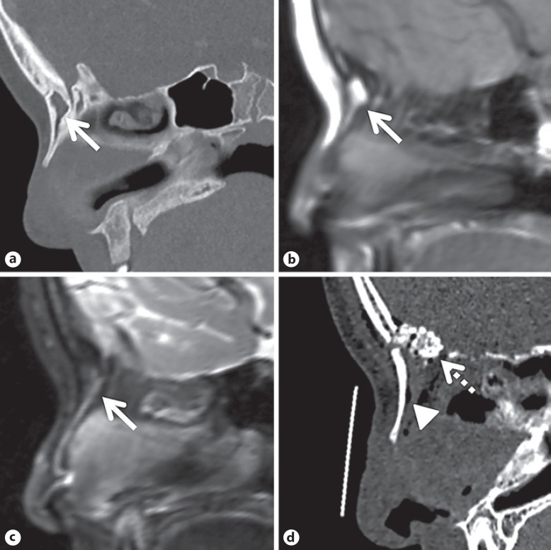 Images in Pediatric Neurosurgery: Occult Intraosseous Dermoid Cyst at the Nasofrontal Junction.