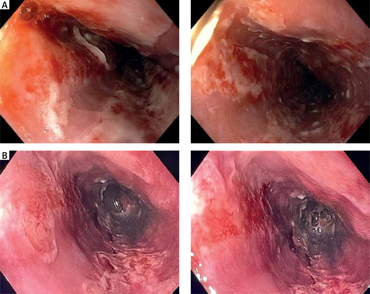 Esoxx added to standard therapy accelerates the healing of esophagitis.