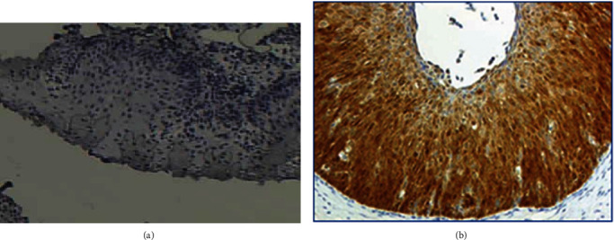 Diagnostic Accuracy of p16<sup>INK4a</sup>/Ki-67 Dual Immunostaining for Detection of High-Grade Cervical Intraepithelial Neoplasia in Women Involved in Cervical Cancer Screening in Georgia.