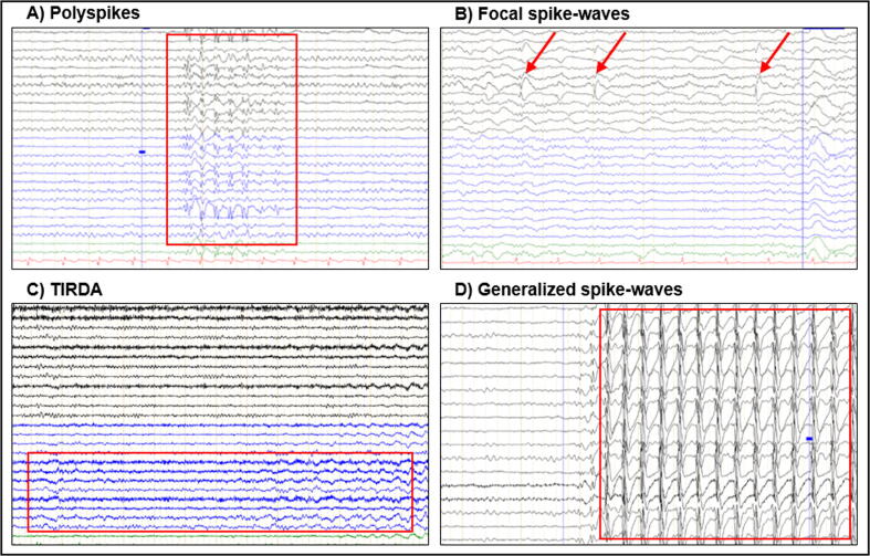 EEG biomarker candidates for the identification of epilepsy