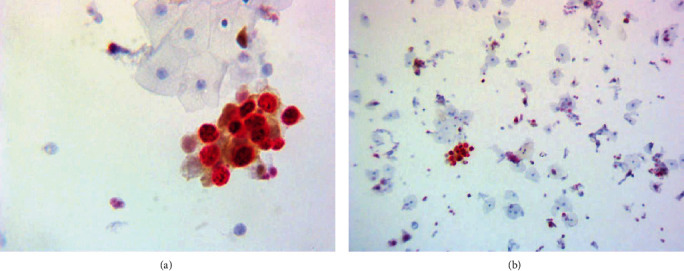 Diagnostic Accuracy of p16<sup>INK4a</sup>/Ki-67 Dual Immunostaining for Detection of High-Grade Cervical Intraepithelial Neoplasia in Women Involved in Cervical Cancer Screening in Georgia.