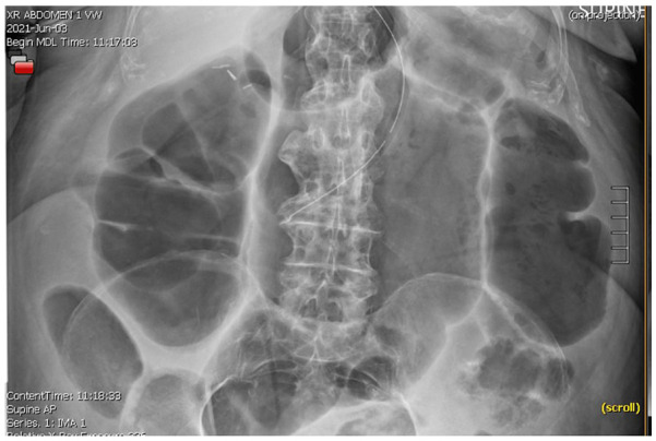 Ogilvie Syndrome, Bradycardia, and Neostigmine.