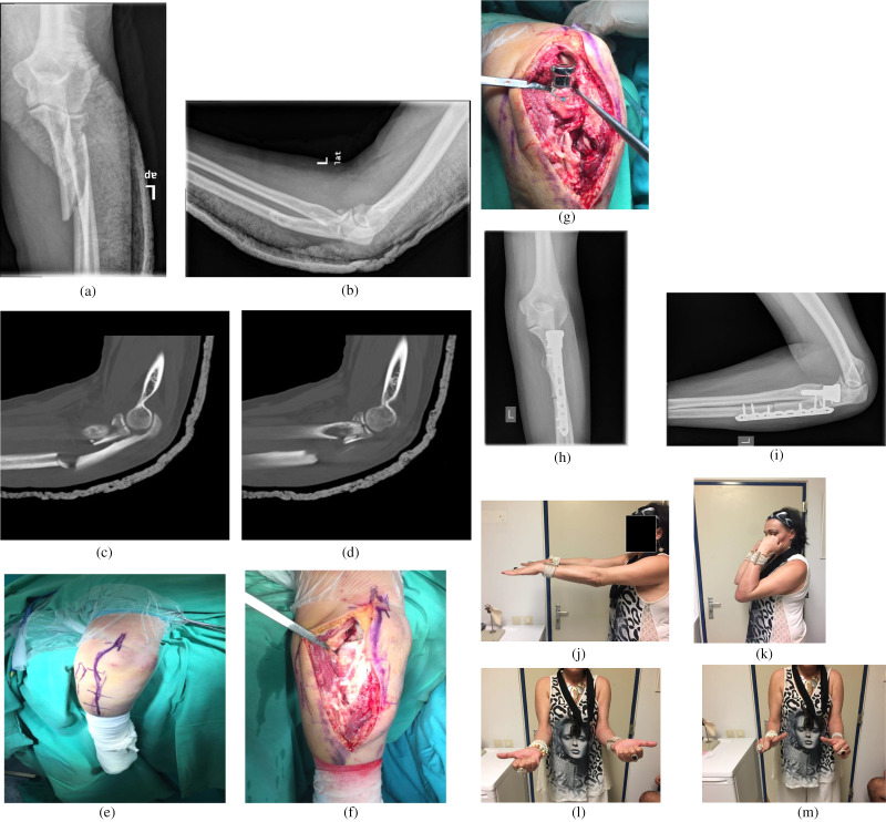 Surgical Treatment of Monteggia-Like Lesions With a Modified Boyd Approach.