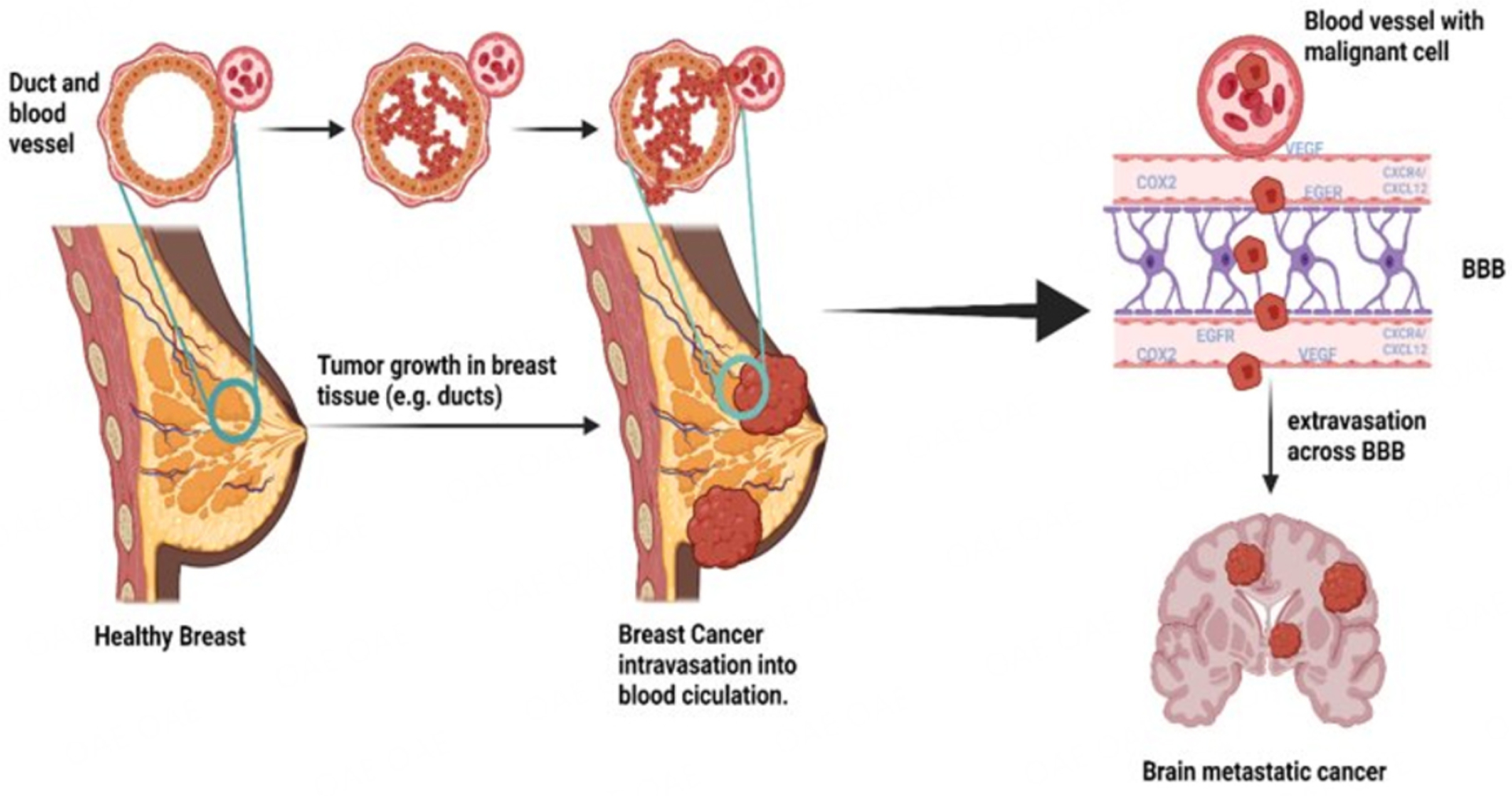 Advanced breast cancer metastasized in the brain: treatment standards and innovations.