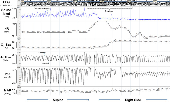 Snoring and aortic dimension in Marfan syndrome.