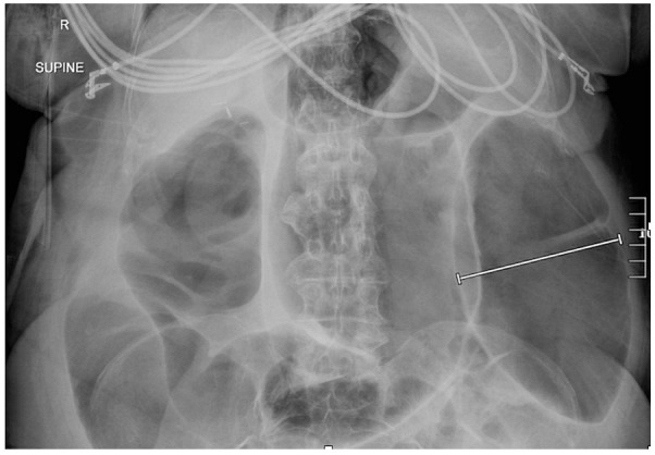 Ogilvie Syndrome, Bradycardia, and Neostigmine.