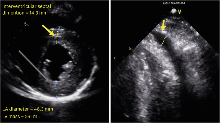 A case of syncope in a villager with hypertrophic cardiomyopathy after hydrogen sulfide exposure by an unauthorized discharge of wastewater.