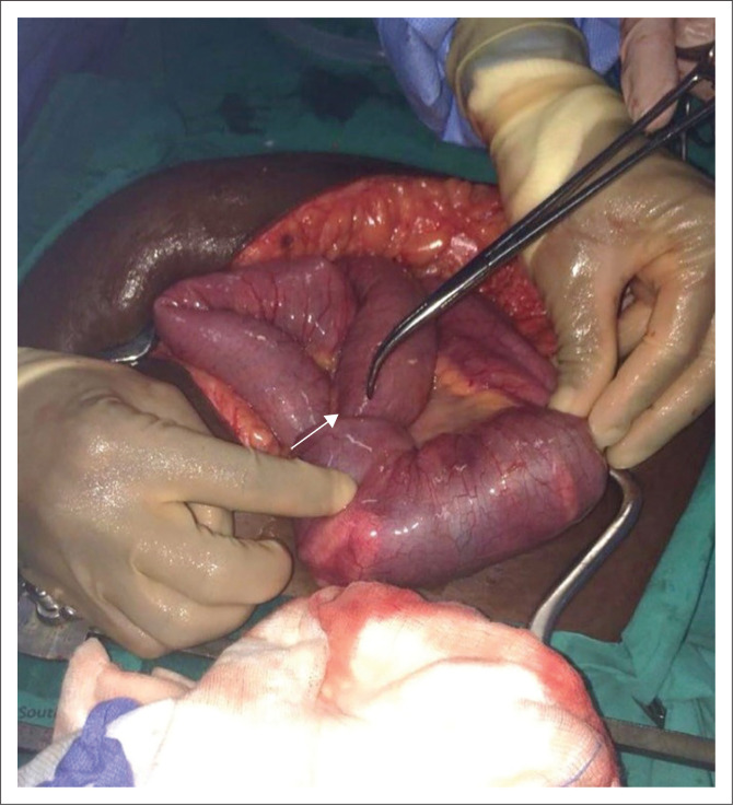 Adult intussusception in the era of HIV/AIDS: A case report.