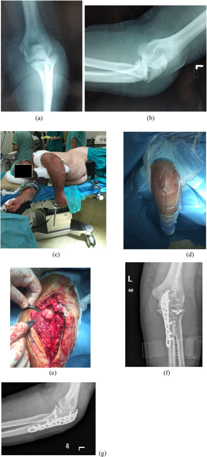 Surgical Treatment of Monteggia-Like Lesions With a Modified Boyd Approach.