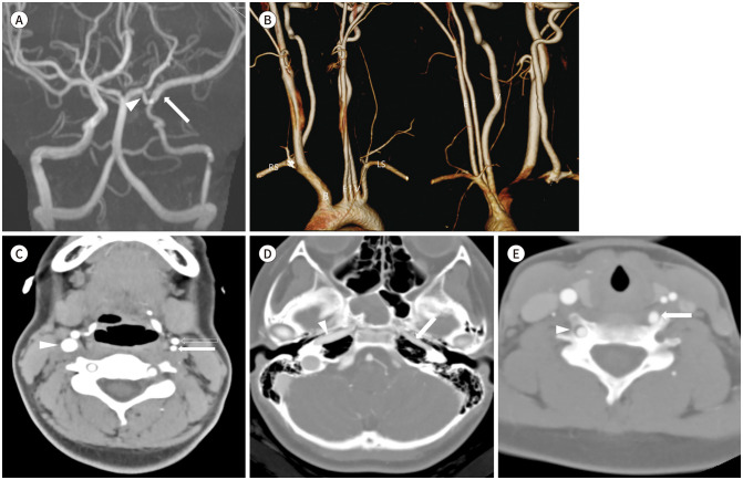 Combined Anatomical Anomalies of Direct Aortic Arch Origins of the Left Internal Carotid, Left External Carotid, and Left Vertebral Arteries: A Case Report.