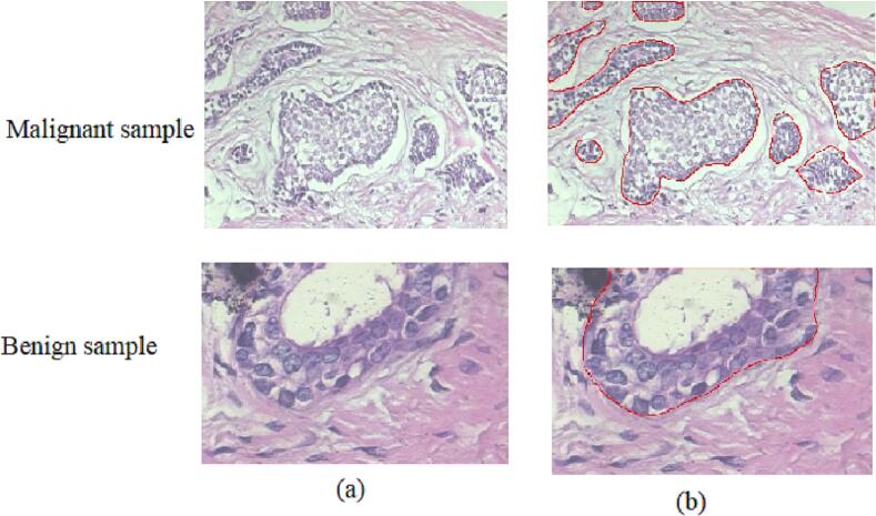 An interpretable decision-support model for breast cancer diagnosis using histopathology images