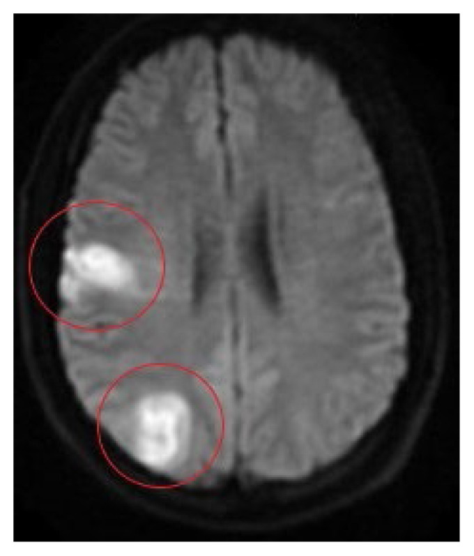 Ischemic Stroke in the Setting of Anabolic Androgenic Steroid Use.