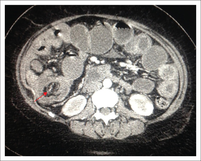 Adult intussusception in the era of HIV/AIDS: A case report.