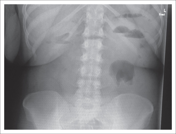 Adult intussusception in the era of HIV/AIDS: A case report.