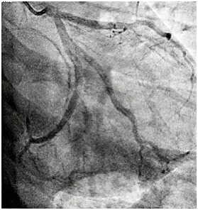 ST-Segment Elevation Acute Myocardial Infarction Associated to Covid-19 Vaccination in A Healthy Young Adult with Normal Coronary Arteries.