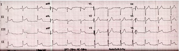 ST-Segment Elevation Acute Myocardial Infarction Associated to Covid-19 Vaccination in A Healthy Young Adult with Normal Coronary Arteries.