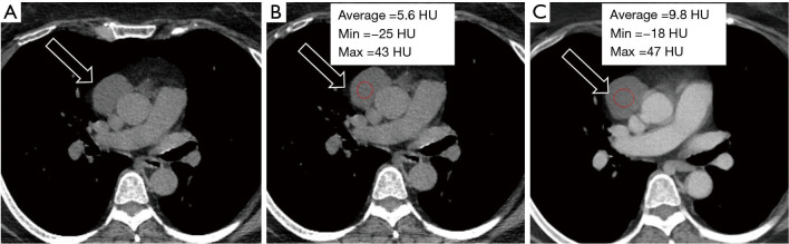 Imaging modalities (MRI, CT, PET/CT), indications, differential diagnosis and imaging characteristics of cystic mediastinal masses: a review.