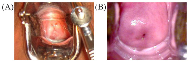 Monotherapy With a Non-Hormonal Centella Asiatica, Hyaluronic Acid, and Prebiotic-Based Vaginal Gel in Women With Bacterial Vaginosis: Case Series.