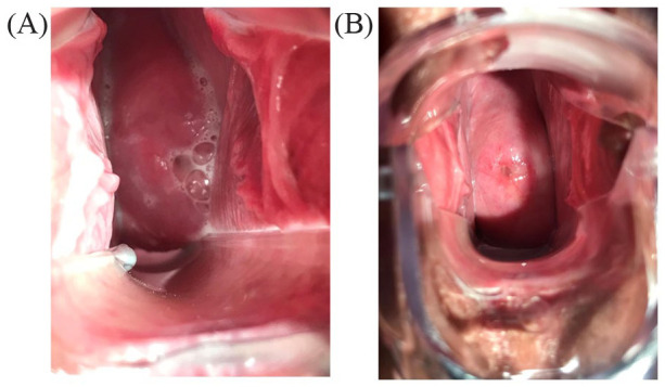 Monotherapy With a Non-Hormonal Centella Asiatica, Hyaluronic Acid, and Prebiotic-Based Vaginal Gel in Women With Bacterial Vaginosis: Case Series.