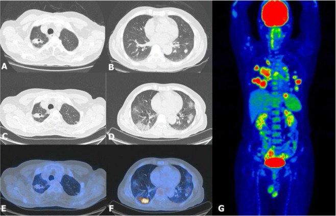 F-18 FDG PET/CT as a One-Stop Shop Imaging Modality for Assessment of Neurologic and Pulmonary Manifestations of COVID-19.