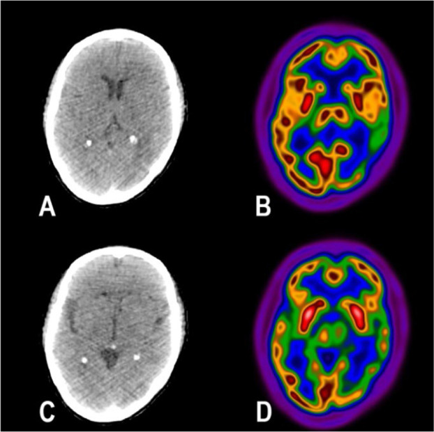 F-18 FDG PET/CT as a One-Stop Shop Imaging Modality for Assessment of Neurologic and Pulmonary Manifestations of COVID-19.