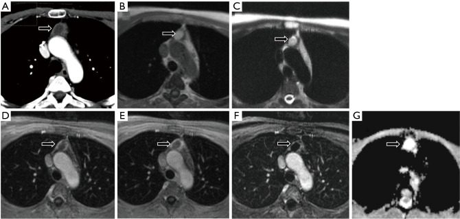 Imaging modalities (MRI, CT, PET/CT), indications, differential diagnosis and imaging characteristics of cystic mediastinal masses: a review.