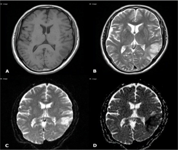 F-18 FDG PET/CT as a One-Stop Shop Imaging Modality for Assessment of Neurologic and Pulmonary Manifestations of COVID-19.