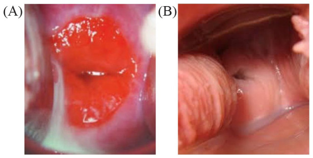 Monotherapy With a Non-Hormonal Centella Asiatica, Hyaluronic Acid, and Prebiotic-Based Vaginal Gel in Women With Bacterial Vaginosis: Case Series.