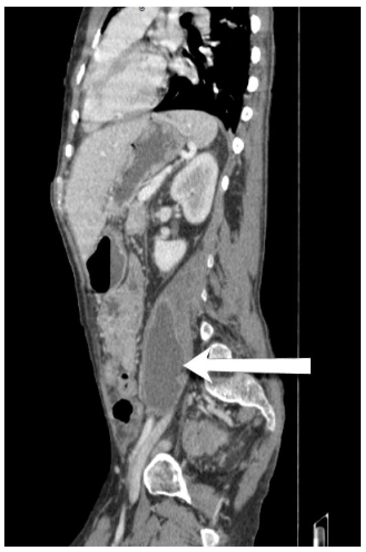 Disseminated MAI in an HIV Patient-An Unusual Presentation.