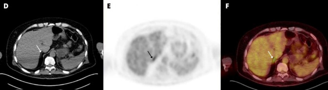 Prominent <sup>18</sup>F-FDG Uptake in the Adrenal Gland after Contralateral Adrenalectomy in a Known Case of Adrenocortical Oncocytic Carcinoma.