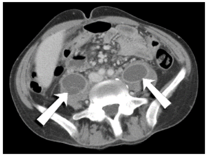 Disseminated MAI in an HIV Patient-An Unusual Presentation.