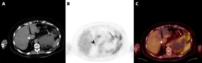 Prominent <sup>18</sup>F-FDG Uptake in the Adrenal Gland after Contralateral Adrenalectomy in a Known Case of Adrenocortical Oncocytic Carcinoma.