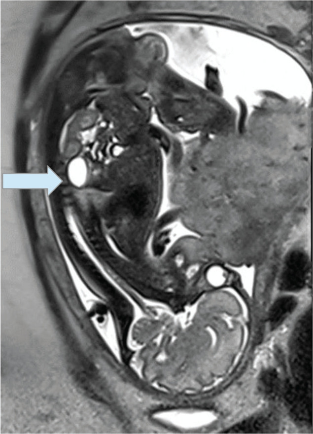 Prenatal diagnosis of an adrenal mature teratoma mimicking a neuroblastoma.